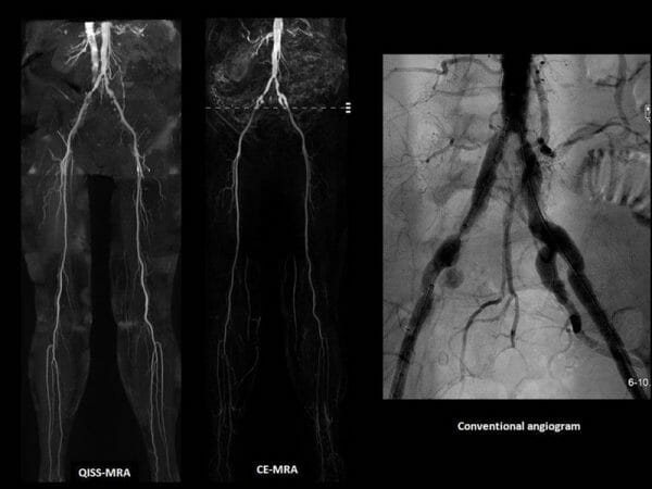 peripheral angiogram images show blood flow in arteries