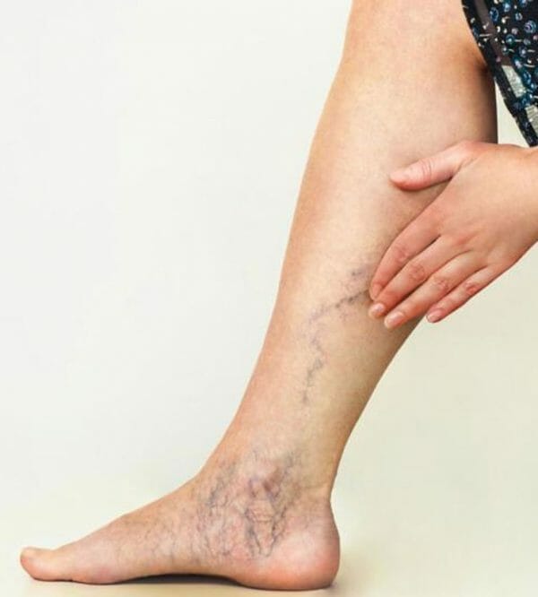 How Do Compression Stockings Improve My Vascular Health? - Advanced Vein &  Laser Center