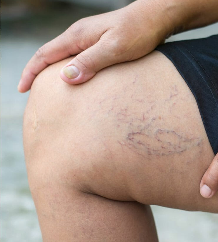 Spider Veins Treatment Prescott