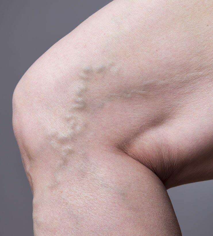 tips to prevent varicose veins