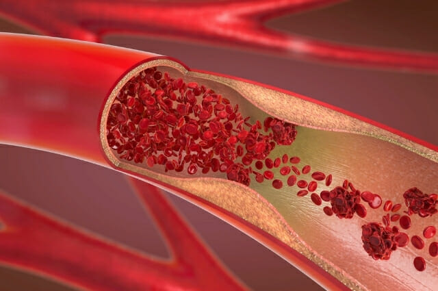 Arterial Blockages Treatment Prescott