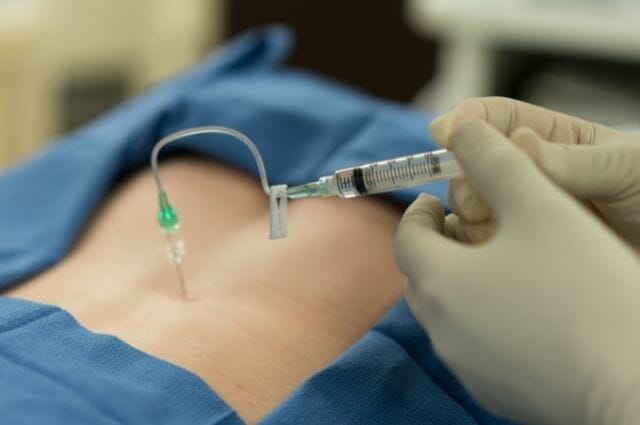 Epidural Steroid Injections for Back Pain Relief