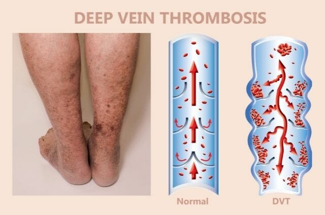 deep vein thrombosis