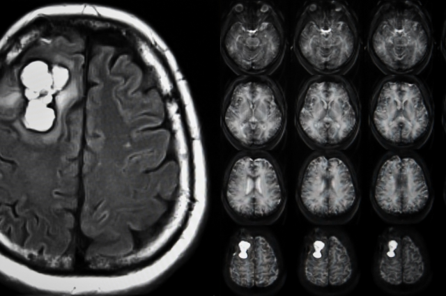 brain tumor ct scan