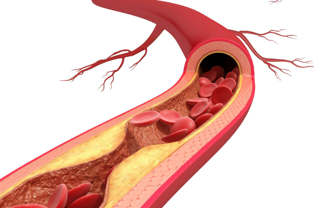 atherosclerosis leading to peripheral artery disease