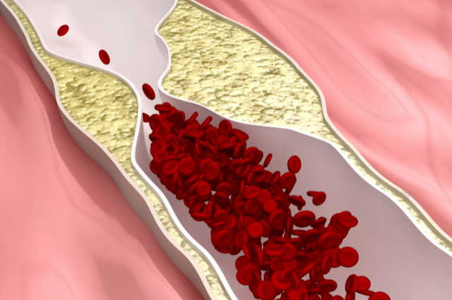 what are the symptoms of a blocked artery in your leg