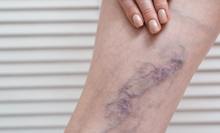 The Top 3 Warning Signs of DVT (Deep Vein Thrombosis) - VISP