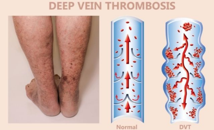 Critical Symptoms Of Deep Vein Thrombosis You Should Know - ACTIV LIVING  COMMUNITY