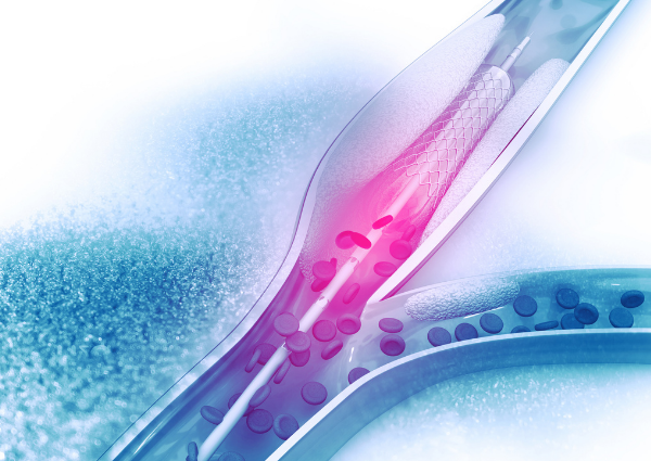 Atherosclerosis Symptoms Prescott