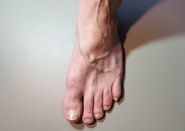 varicose veins