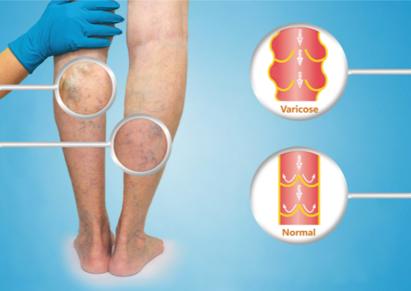 get rid of varicose veins in legs