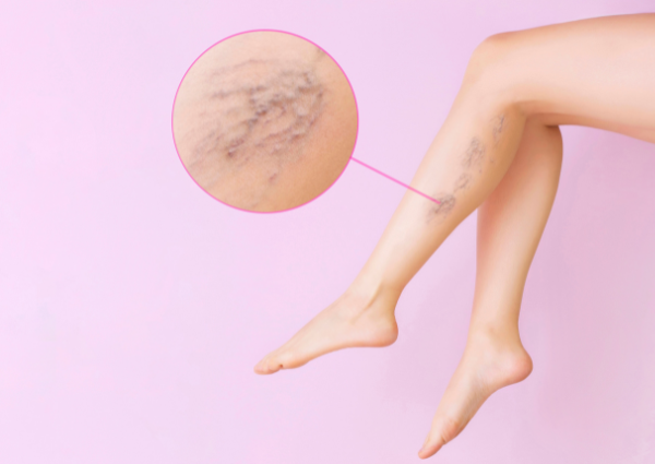 Are There Ways to Avoid Varicose Veins?: Vascular Specialists