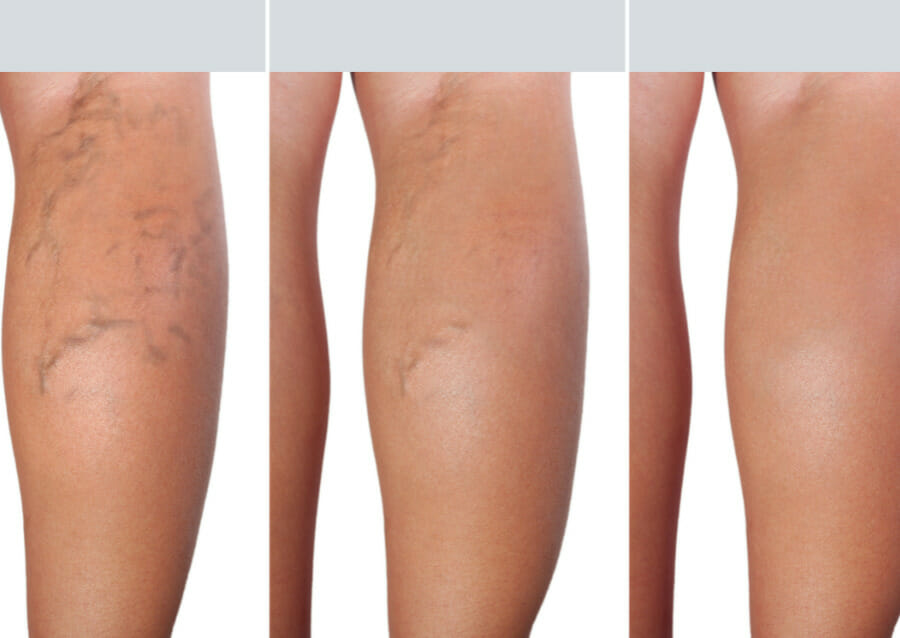 Sclerotherapy for Varicose Veins Results