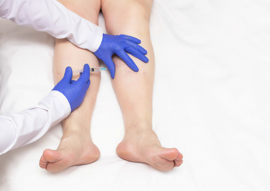 Sclerotherapy for Varicose Veins