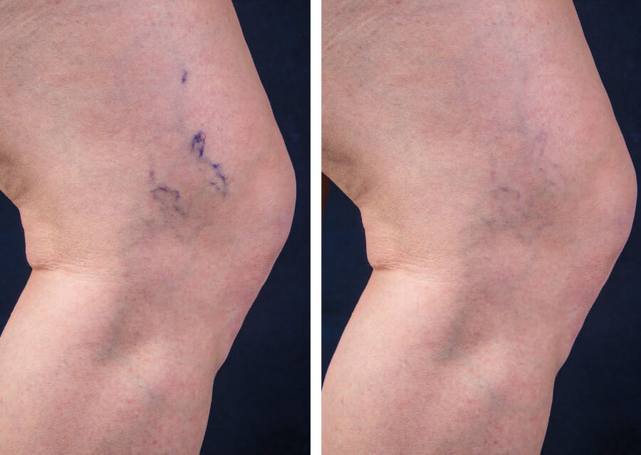 Varicose Veins Treatment before and after