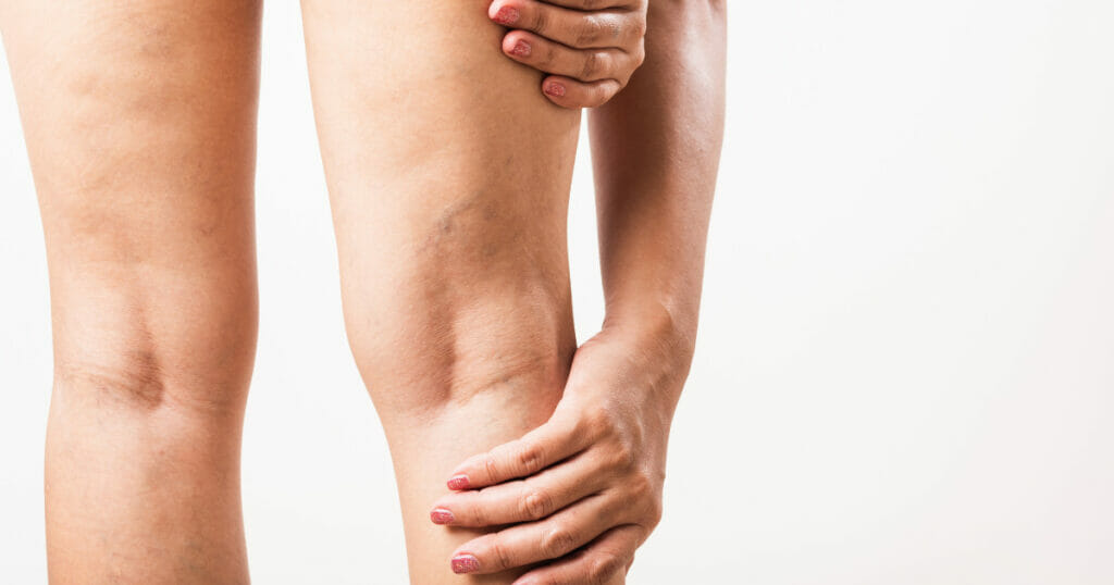 what is sclerotherapy