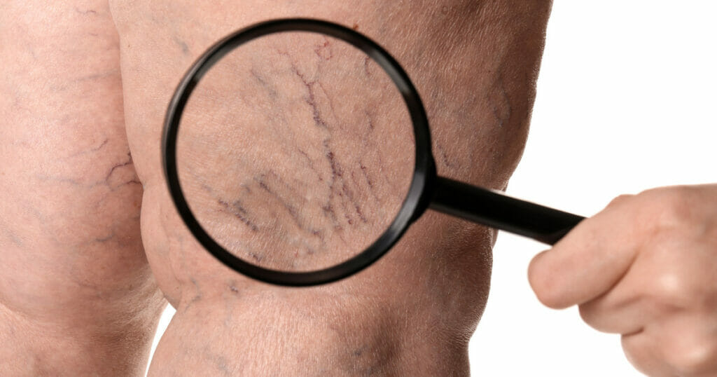 varicose veins