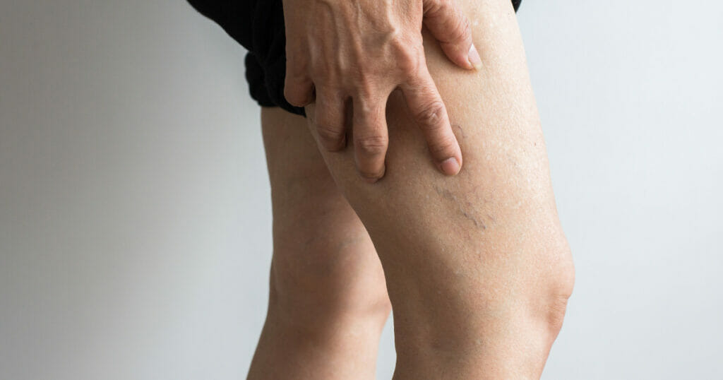 sclerotherapy for varicose veins