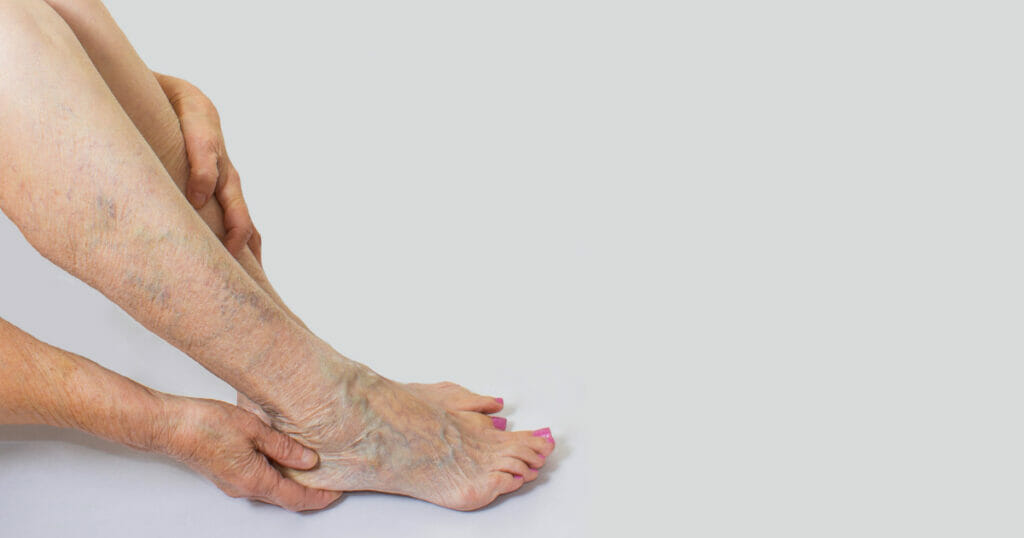 what to do after sclerotherapy treatment