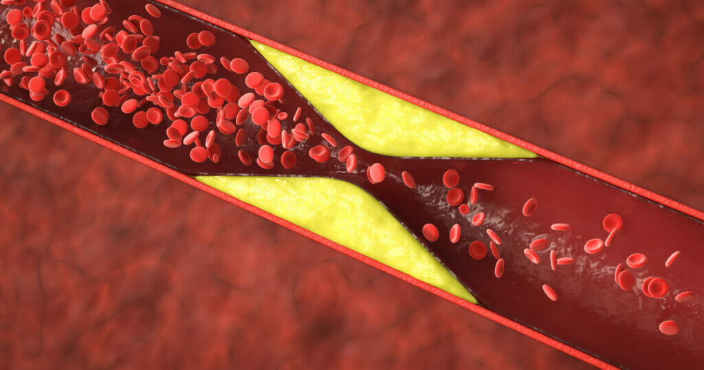 atherosclerosis treatment Prescott