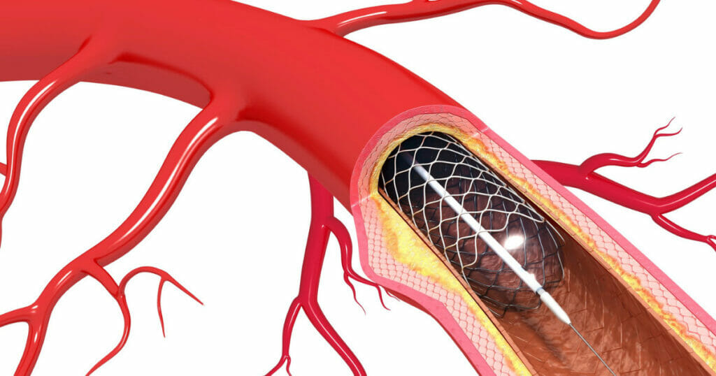 Minimally invasive procedures - Radiologists Prescott