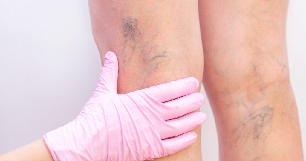 hand in pink gloves checking the veins on the back of a leg