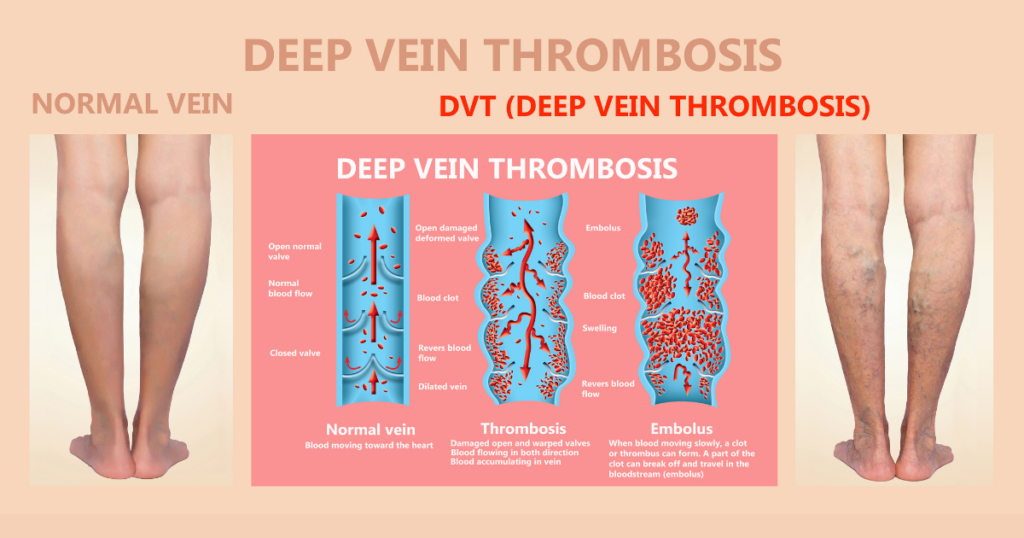 normal vein vs deep vein thrombosis