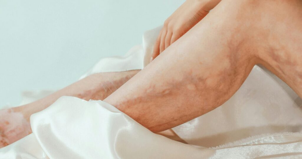 deep vein trombosis treatment