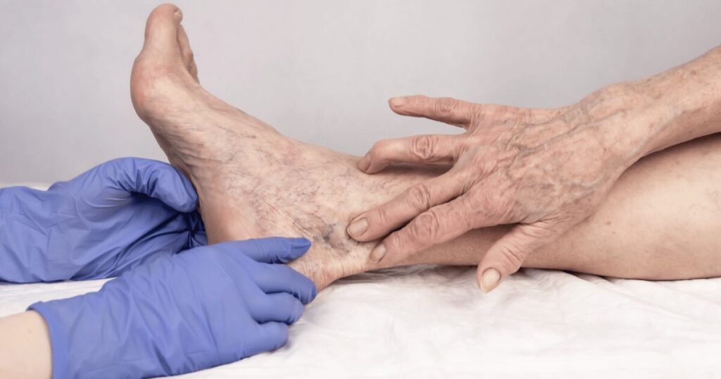 doctor pointing to varicose vein