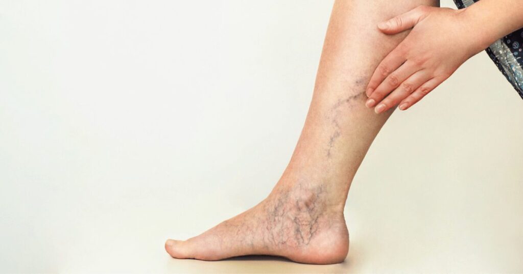 leg with severe varicose veins