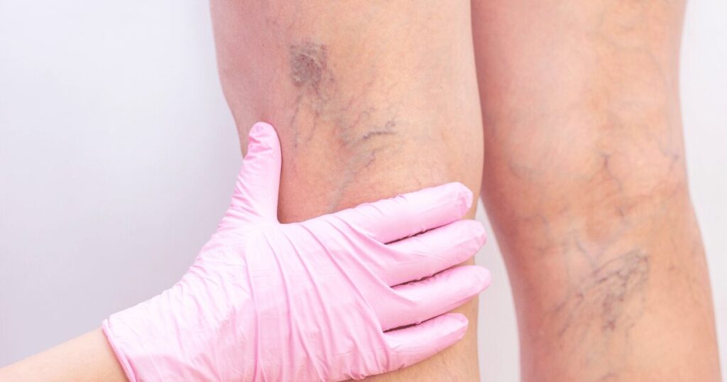 vein specialist handling a leg with varicose veins