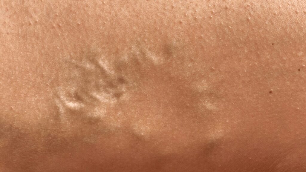 deep vein thrombosis