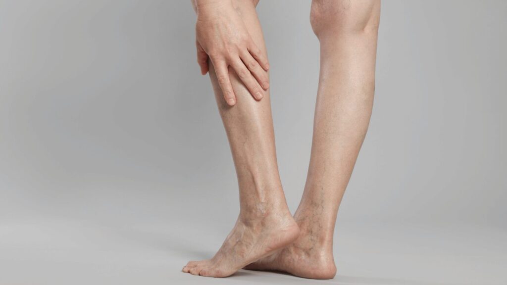 Closeup View of Woman with Varicose Veins on Light Grey Background