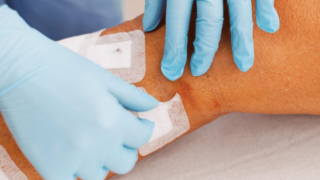 Nurse is taking care of patient after vein stripping