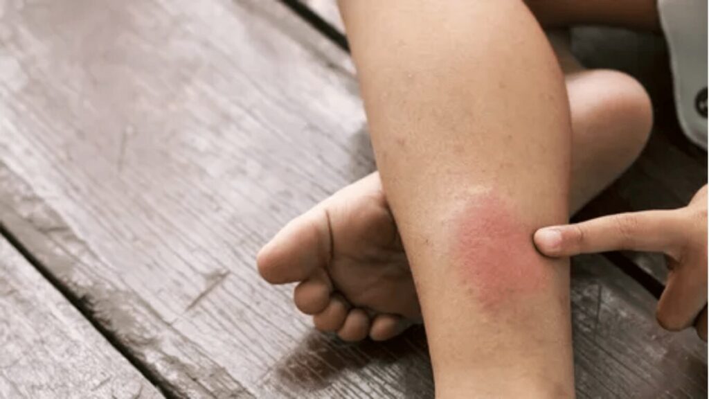 Person showing a red, irritated rash on the side of their leg