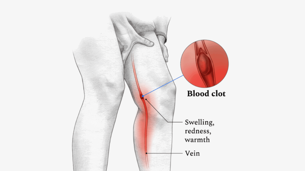 an illustration of a leg showing a blood clot