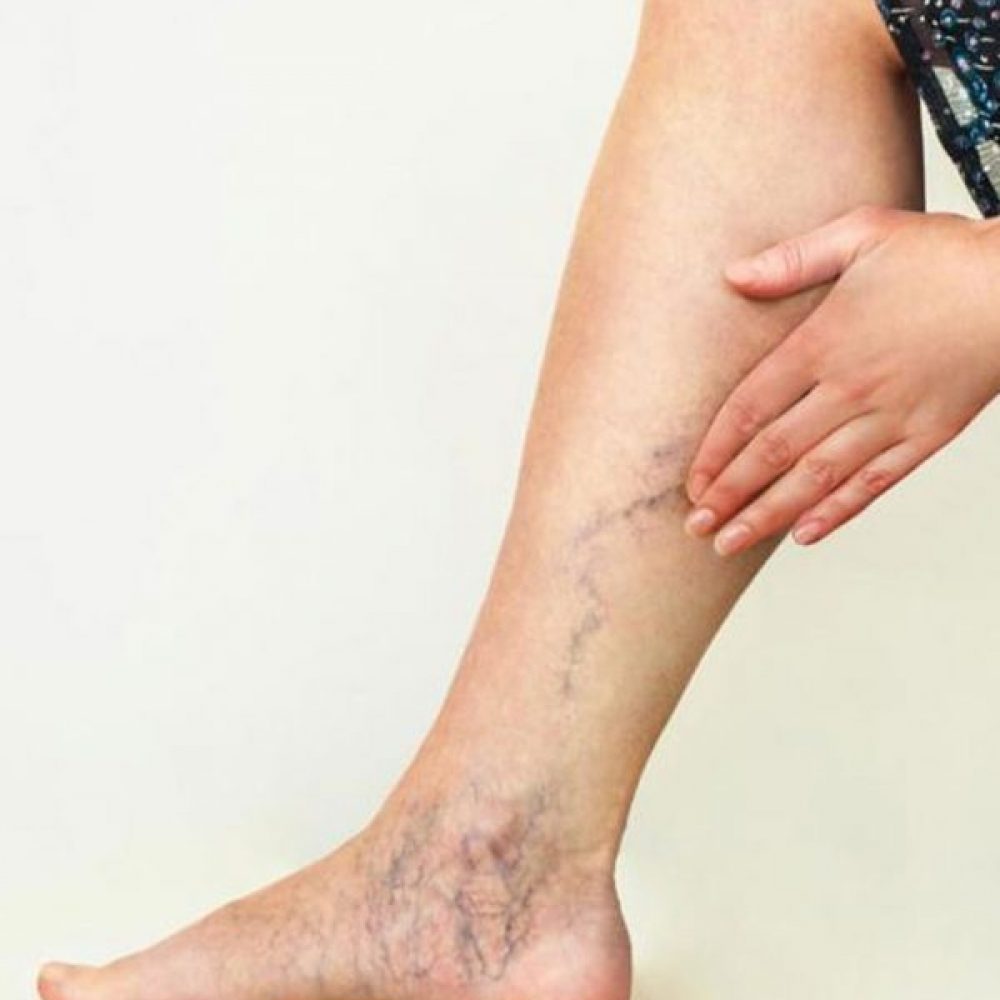 Vein Removal Guide for Patients