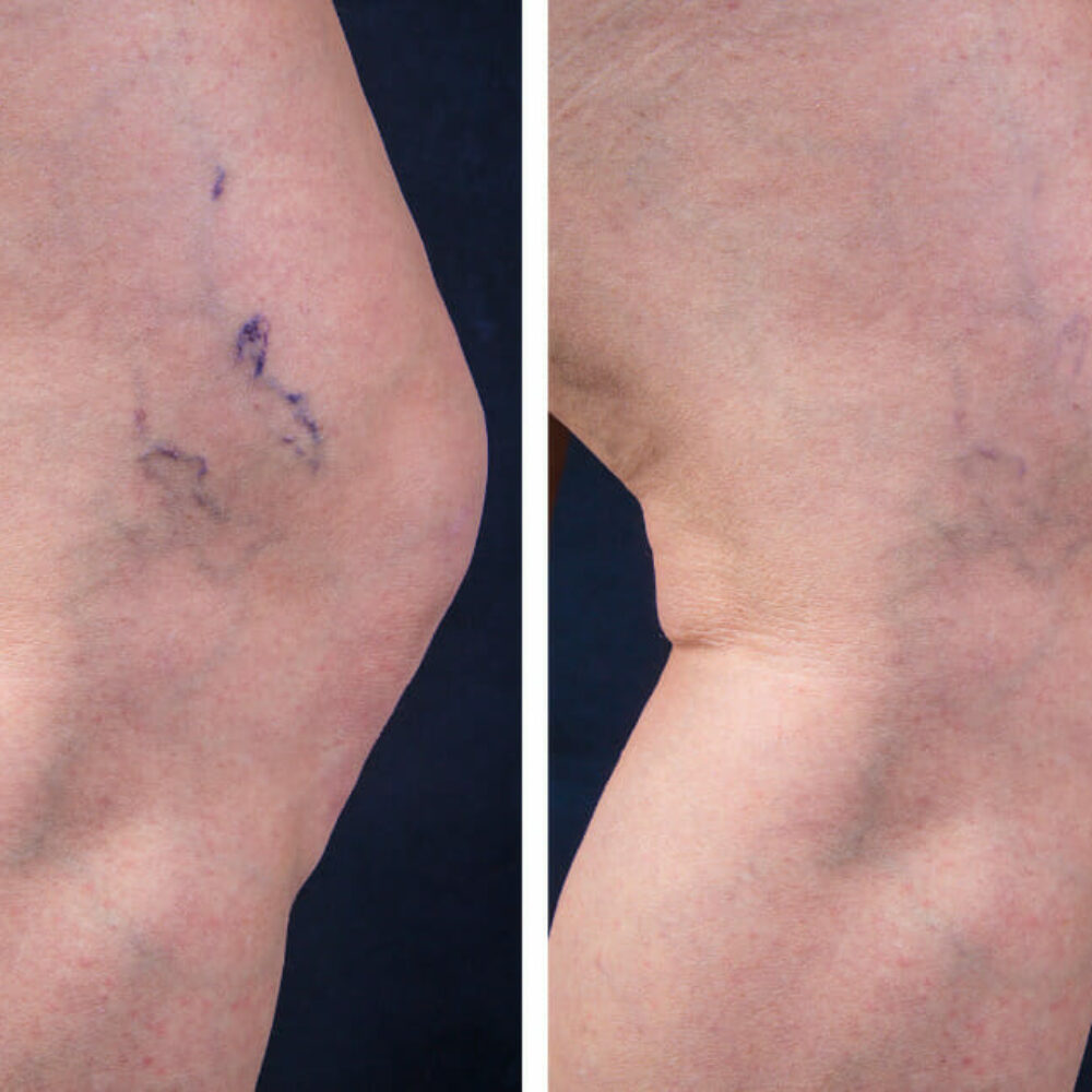 Sclerotherapy for Varicose Veins: How Does It Work?