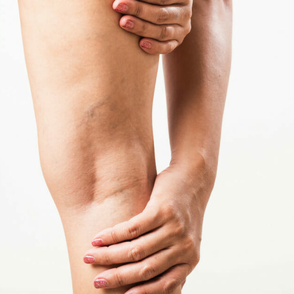 What Is Sclerotherapy?