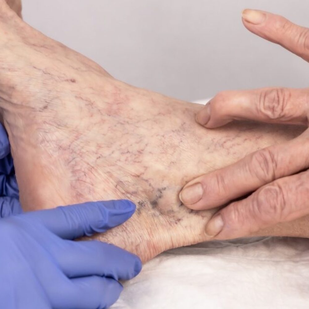 How Long Does Sclerotherapy Last?