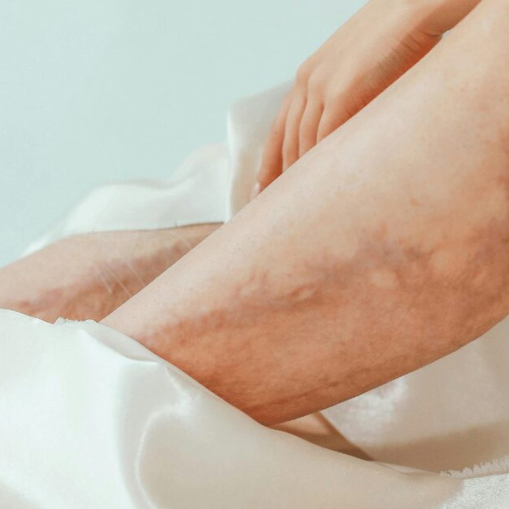 DVT vs Varicose Veins: How to Spot the Difference