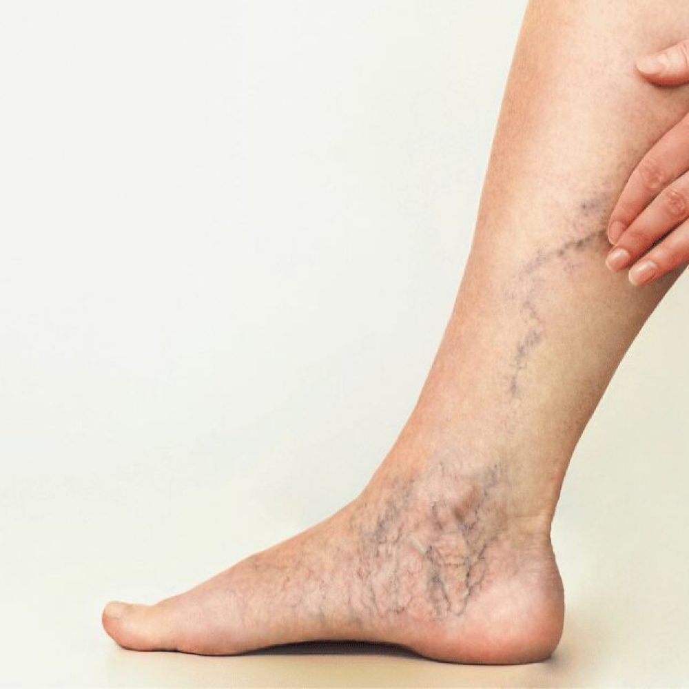 Can a Varicose Vein Burst? (&#038; What Happens If It Does?)