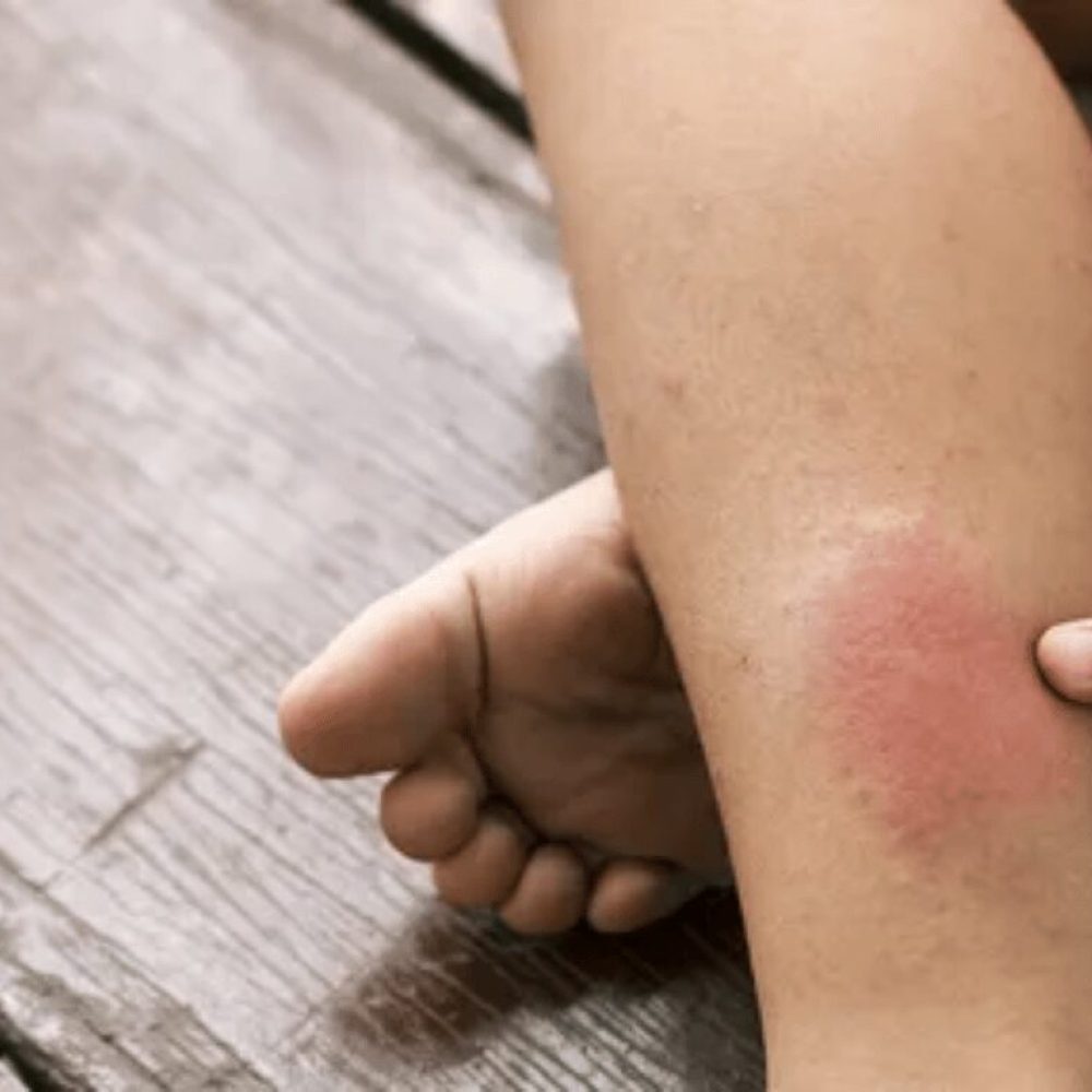 Early Stage Blood Clot in Leg Symptoms: 5 Major Signs