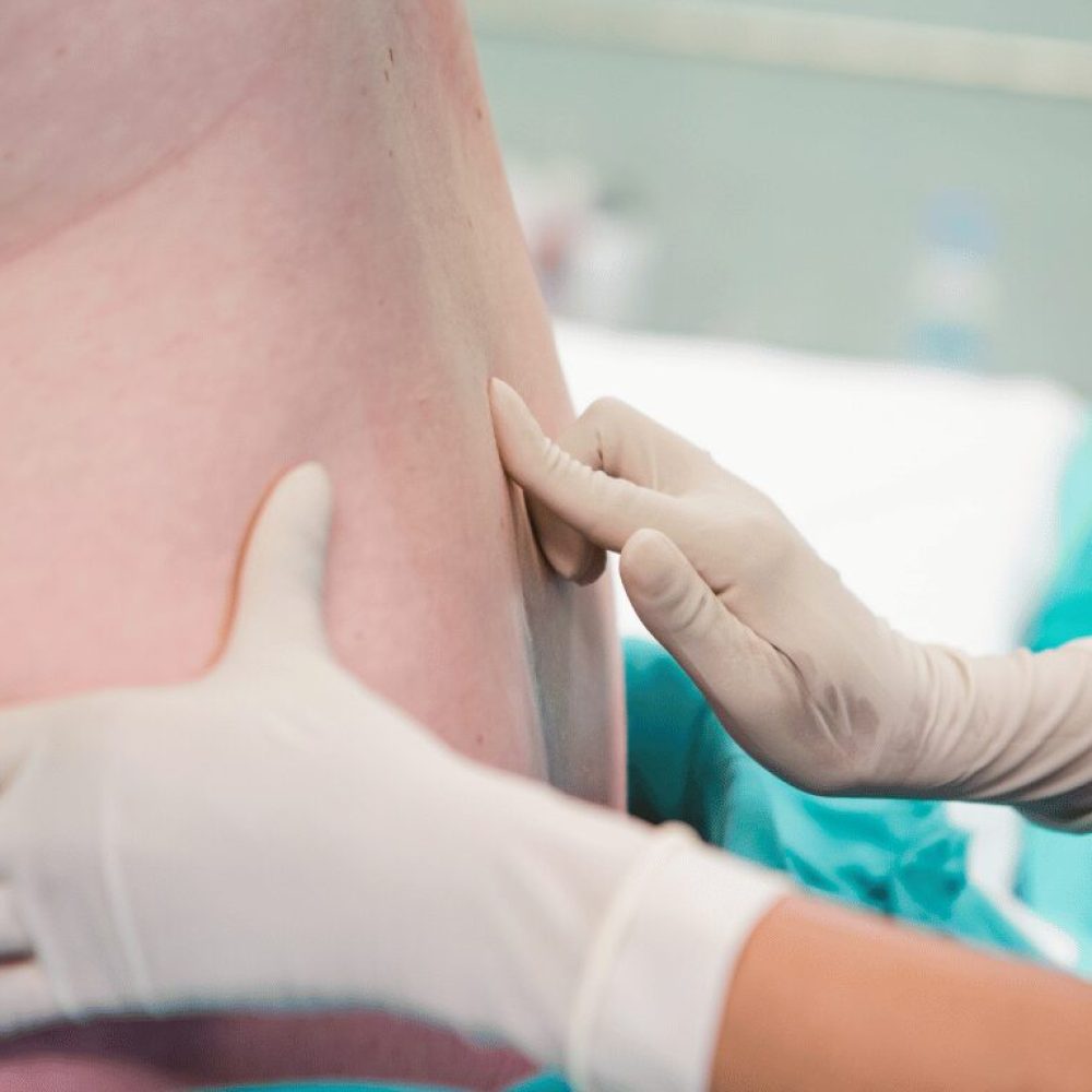 Epidural vs. Nerve Block: What’s the Difference?