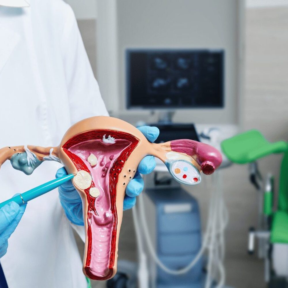 Why Fibroids Cause Heavy Bleeding