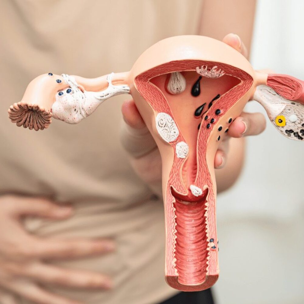 Uterine Fibroid Embolization: A Complete Patient Guide