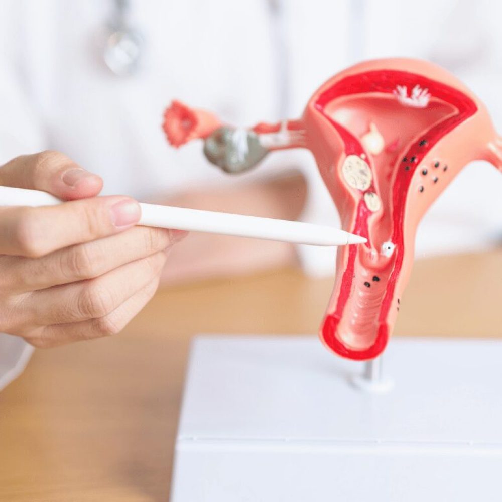 Can Fibroids Cause Back Pain? Signs and What to Do