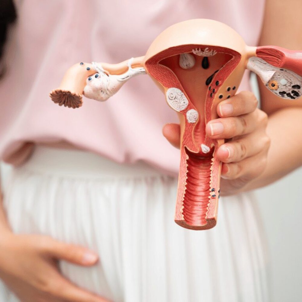 UFE vs. Hysterectomy: A Side-by-Side Comparison